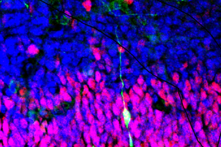 Parkinson, trapianto di staminali nel cervello di 8 pazienti